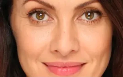 Hilos tensores: técnica mínimamente invasiva y su impacto en la medicina estética actual